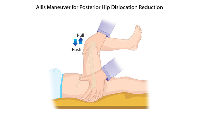Allis Maneuver for Posterior Hip Dislocation Reduction
Orthopedic illustration demonstrating the Allis maneuver technique used for closed reduction of posterior hip dislocation with traction.