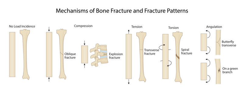 Mechanisms of Bone Fracture and Fracture Patterns
Medical diagram illustrating how various physical forces produce specific bone fracture types such as spiral, transverse, oblique.