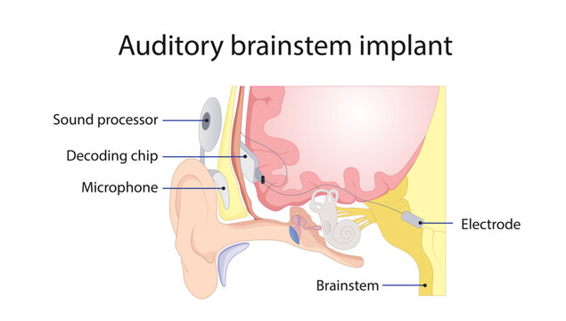 Auditory Brainstem Implant
Medical illustration showing the components and placement of an auditory brainstem implant used for hearing rehabilitation in patients with cochlear nerve disorders.