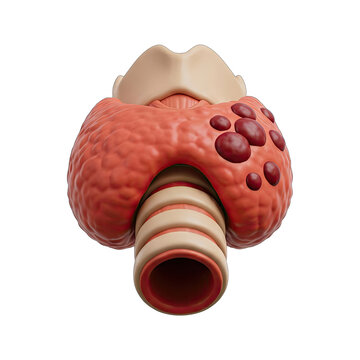 3D Illustration of Thyroid Gland with Nodules
