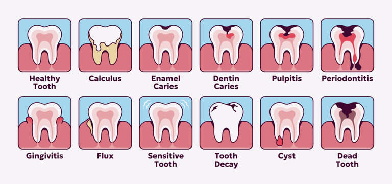Tooth disease icon set. Collection of dental problems and oral health. Calculus, flux, gingivitis, caries, cyst, pulpitis, periodontitis. Vector illustration for dentistry and healthcare concepts.