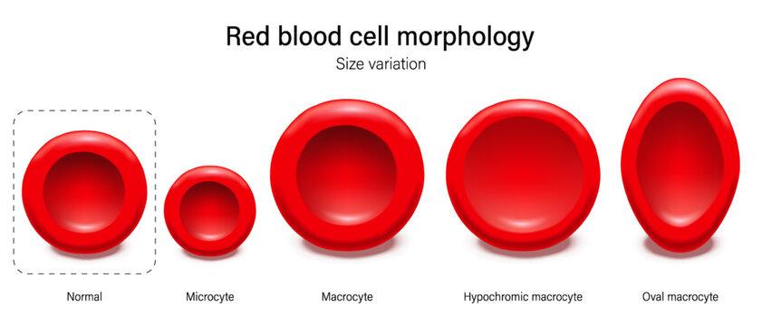 Red blood cell morphology. Size variation of erythrocytes. Normal, Microcyte, Macrocyte, Hypochromic microcyte and Oval macrocyte.
