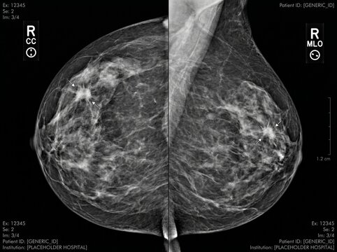 Stage 1 Breast Cancer Mammogram Images Showing Early Tumor Detection in Breast Screening Scan