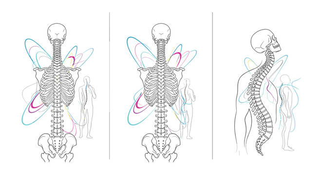 Comparative medical illustration showing three views of human skeleton focusing on spinal alignment posture and backbone curvature for clinical analysis.