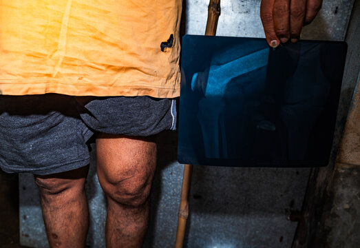 Osteoarthritis is a degenerative joint disease characterized by the wearing down of protective cartilage, causing joint pain and stiffness, and decreased ability to move freely. joint pain, stiffness.