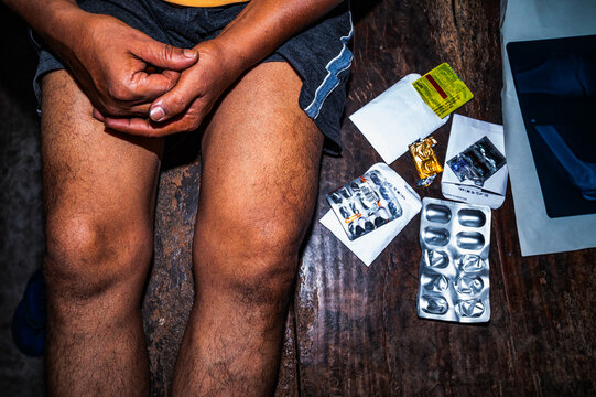 Osteoarthritis is a degenerative joint disease characterized by the wearing down of protective cartilage, causing joint pain and stiffness, and decreased ability to move freely. joint pain, stiffness.