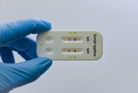 Blood sample of patient positive result for scrub typhus.