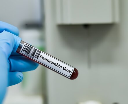 Blood sample tube for prothrombin time test analysis.