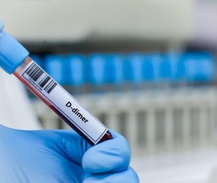Blood sample tube for D-dimer test analysis.