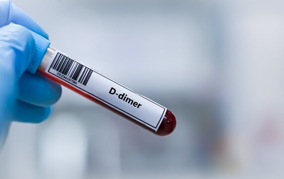 Blood sample tube for D-dimer test analysis.