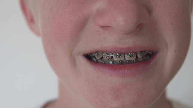 Close-up of a teenage boy smiling with dental braces. Cropped portrait focusing on mouth and teeth during orthodontic treatment, showing metal braces and dental care for adolescents