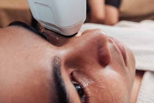 Closeup of a young handsome male client receiving 2D HIFU treatment on the cheek and under eye area for skin tightening.