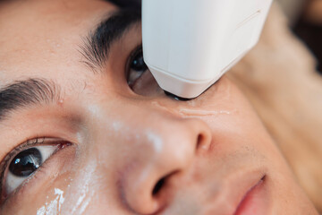 Closeup of a young handsome male client receiving 2D HIFU treatment on the cheek and under eye area...