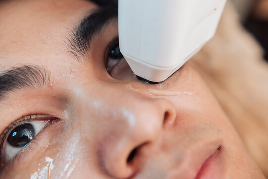 Closeup of a young handsome male client receiving 2D HIFU treatment on the cheek and under eye area for skin tightening.