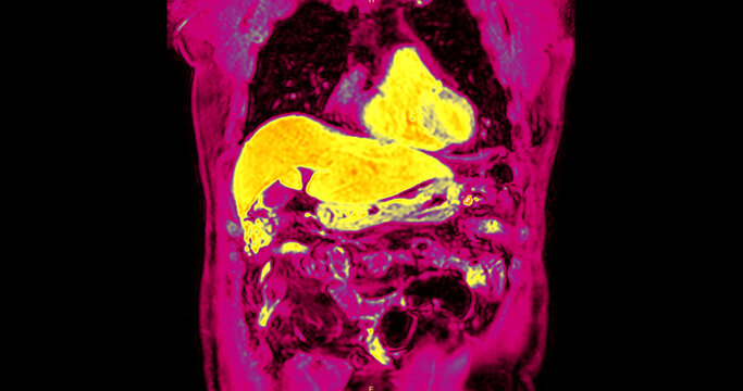 False-color magnetic resonance imaging (MRI) scan of a healthy human upper abdomen in coronal view, highlighting the liver and internal organs. Perfect for medical technology and healthcare concepts.