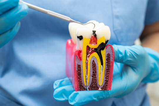 Dentist holding dental implant, artificial tooth roots into jaw, root canal of dental treatment, gum disease, teeth model for dentist.