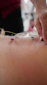 Technician Preparing Electroacupuncture Device. Detailed View Of Wires And Electrodes Used In Therapy Session. Close Detail Of Clinical Equipment Including Circuitry And Electrode Clips In Use