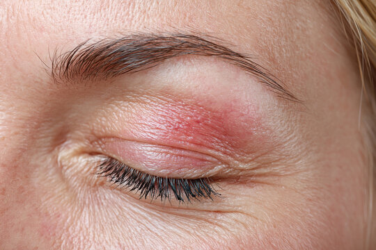 Red eyelid irritation close up skin inflammation on closed eye with fine wrinkles and eyebrow