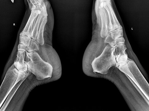 Digital Radiography of Human Ankle Joint Showing Distal Tibia and Fibula Anatomy