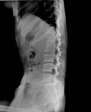 Pelvis Radiograph Assessing Sacroiliac Joints and Hip Osteoarthritis