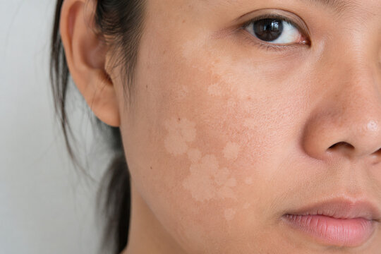 Close Up of Vitiligo White Patches and Uneven Skin Pigmentation on Female Face