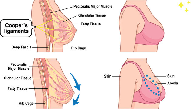 Female Breast Anatomy Diagram Vector Set Showing Sagging Cooper Ligaments Aging Process Medical Illustration with Cross Section and External Bra Support Views