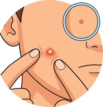 Close-up illustration of a person squeezing a pimple on their cheek with skin problem magnifying glass human body skincare squeezing close-up illustration dermatology cosmetic unhealthy
