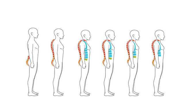 Medical infographic showing the side profile of a human figure with various stages of spinal curvature and posture alignment issues.