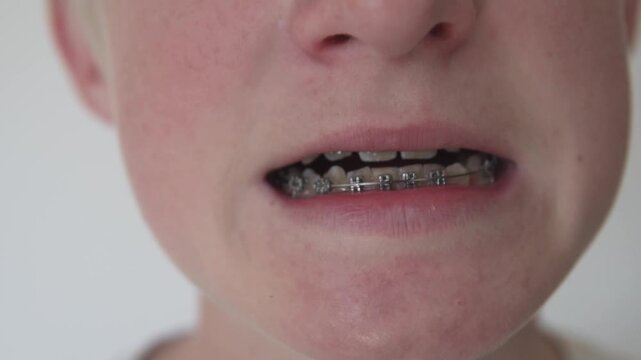 Close-up video of a child showing teeth with metal dental braces. Cropped shot focusing on the mouth and orthodontic treatment, representing dental care, oral health, braces adjustment and adolescence