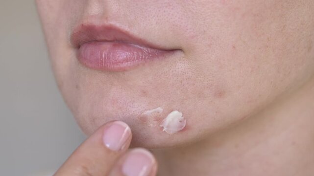 Woman applying moisturizing cream to irritated skin with acne marks and redness on chin. Skincare treatment for blemishes, post-acne recovery and sensitive skin care. Close-up beauty routine.