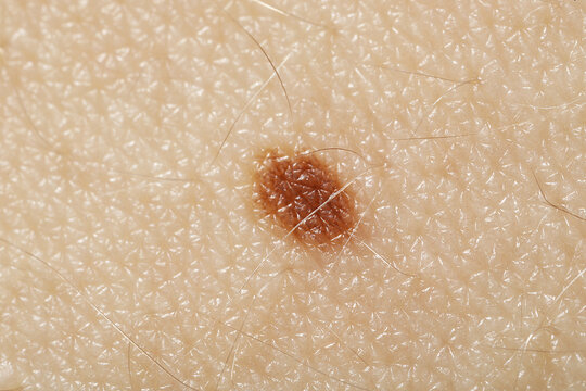 Macro view of skin with birthmark as background