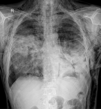 Real Human Digital Chest X-Ray Radiograph 