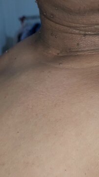 Close up of skin tags and small warts on a man neck and chest area