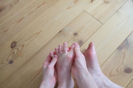 40代女性の水虫になった足