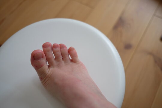 40代女性の水虫になった足