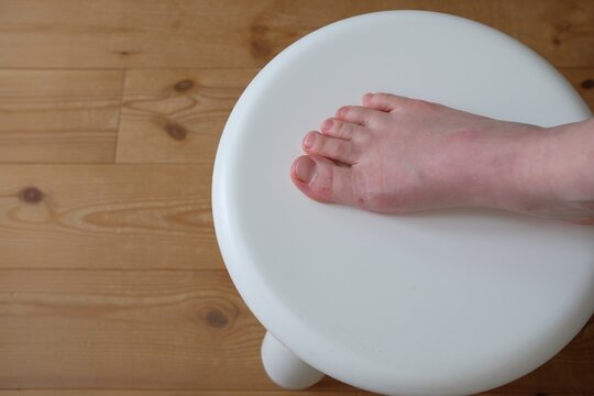 40代女性の水虫になった足