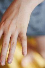Fototapeta premium Swollen and bruised little finger of a child after fracture injury