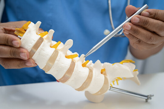 Asian doctor holding spinal nerve and bone model, Lumbar spine displaced herniated disc fragment for treatment medical in the orthopedic department.