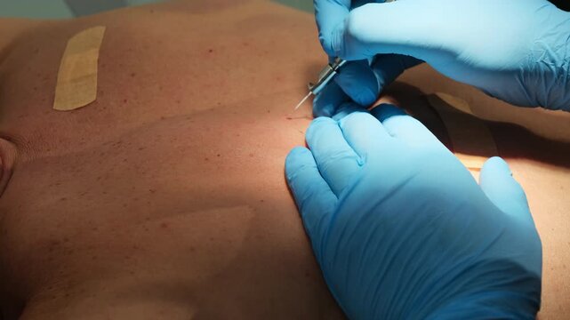 Doctor uses laser coagulation for hemangioma treatment in clinic slow motion. Surgeon reduces size of moles with tool in hospital closeup