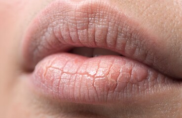 Fototapeta premium Dry Chapped Lips Texture Macro Close Up