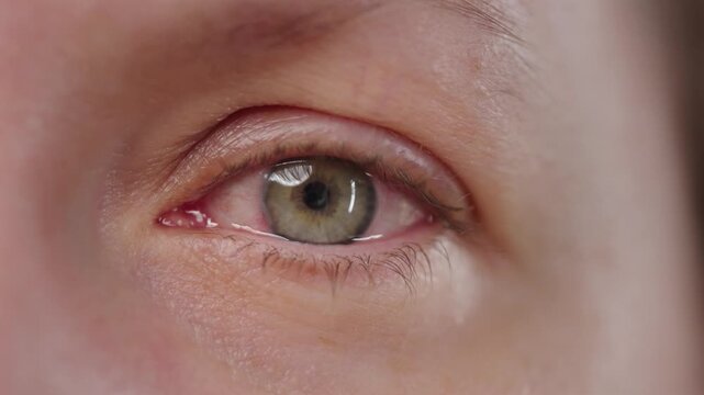Red blood eye of woman affected by conjunctivitis or after flu, cold or allergy