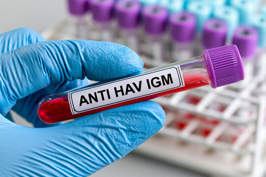 A healthcare professional's hand in a blue medical glove holding a blood sample test tube labeled ANTI HAV IGM for Hepatitis A virus screening and diagnosis in a clinical laboratory setting.