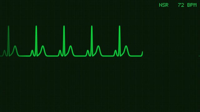 Animated EKG heart rate monitor displaying a green wave normal sinus rhythm