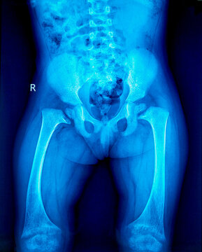 X-ray of child's pelvis and upper legs. Suggestive of Rickets. 
