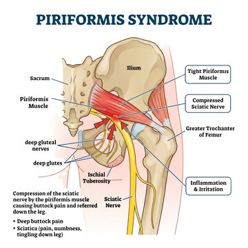Anatomical diagram explains how piriformis syndrome occurs when the muscle compresses the sciatic nerve in the pelvic region, leading to significant discomfort and pain radiating down the lower leg.