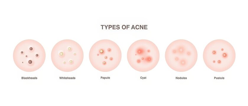 Educational Infographic Illustrating Different Types of Acne Including Blackheads Whitehea