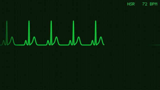 Animated EKG monitor transitioning from normal sinus rhythm to ventricular fibrillation v-fib with flashing alert