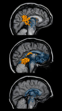 MRI brain activation enhanced cognition study fe be bccfb memory network highlighted in orange and blue overlaid on sagittal MRI showing neural activity and midline structures