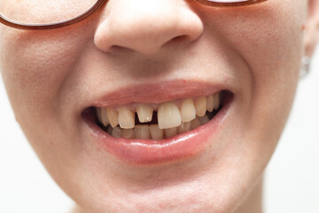 young woman upper jaw central tooth With Dental Implant Abutment © epovdima