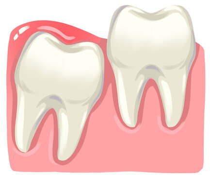 Impacted Wisdom Teeth